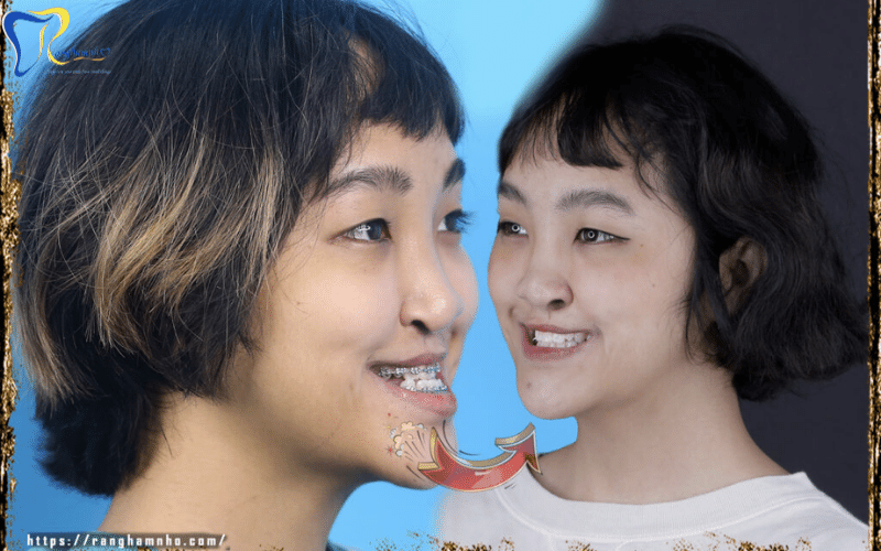 Niềng răng thay đổi khuôn mặt