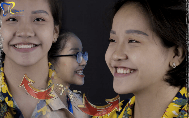 Niềng răng thay đổi khuôn mặt
