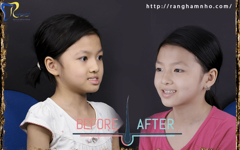 Niềng răng thay đổi khuôn mặt