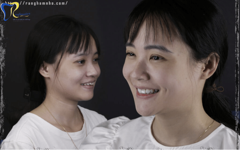 Niềng răng thay đổi khuôn mặt