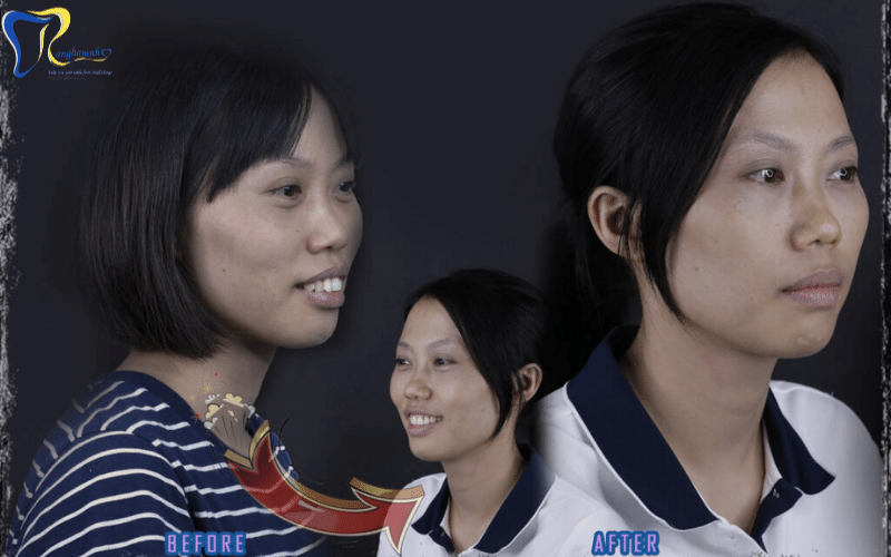 Niềng răng thay đổi khuôn mặt